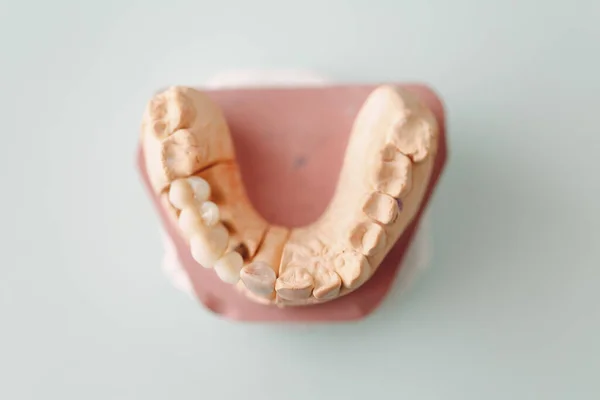 Diseño Dental Mandíbula Humana Con Dientes Implantes Vista Superior —  Fotos de Stock