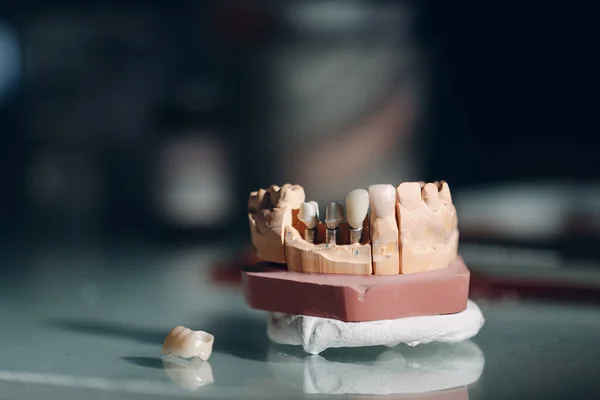 Οδοντιατρική Διάταξη Της Ανθρώπινης Γνάθου Δόντια Και Εμφυτεύματα — Φωτογραφία Αρχείου