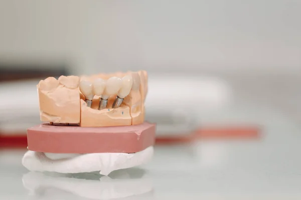 Стоматологическая Компоновка Челюсти Человека Зубами Имплантами — стоковое фото
