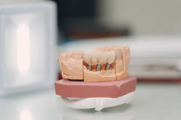 Οδοντιατρική Διάταξη Της Ανθρώπινης Γνάθου Δόντια Και Εμφυτεύματα — Φωτογραφία Αρχείου