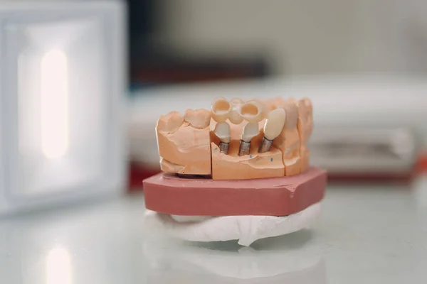 Layout Dentário Mandíbula Humana Com Dentes Implantes — Fotografia de Stock