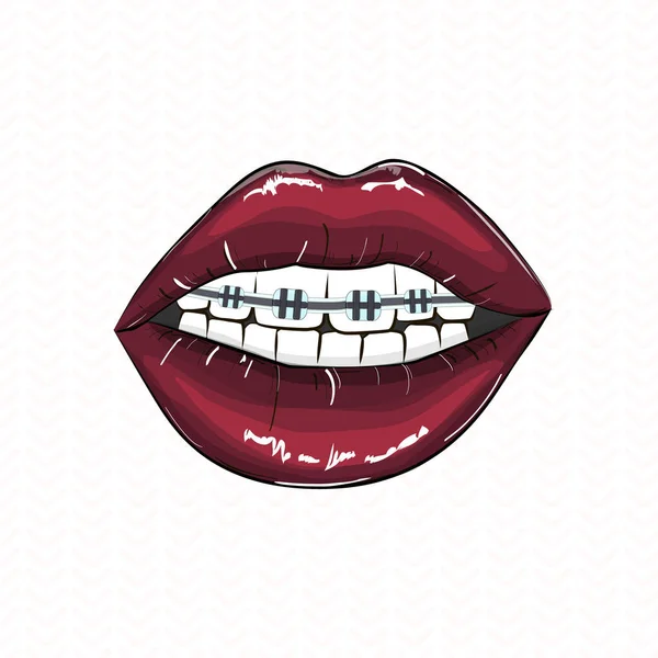 Sexy labios rojos ortodoncia ilustración. Clipart caliente juguetón erótico. Ilustración de moda de sonrisa moderna. Pop art boca abierta con dientes y frenos dentales. Lápiz labial rojo oscuro glamour arte años 80. Impresión sexual — Vector de stock