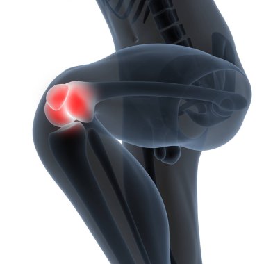 İnsan Vücut Kemiği Eklem Ağrısı (Diz Eklemleri). 3D - Görüntü