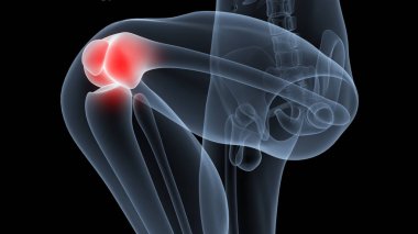İnsan Vücut Kemiği Eklem Ağrısı (Diz Eklemleri). 3D - Görüntü