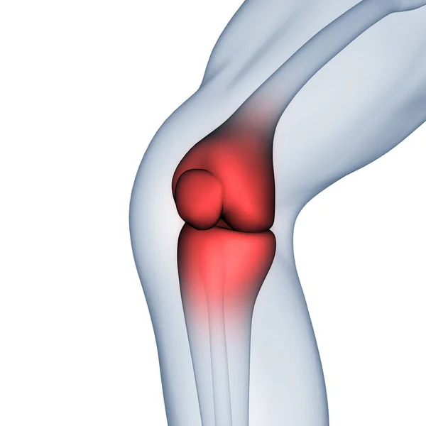 人骨関節痛 膝関節痛 イラスト — ストック写真