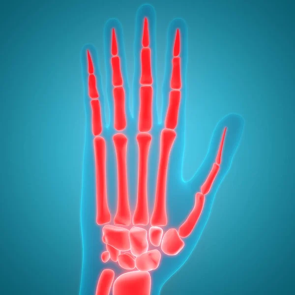 Human Body Bone Joint Pains (Hand Joint) - Illustration