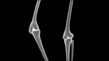 İnsan Vücut Kemiği Eklem Ağrıları (Tibia ve Fibula eklemleri). 3D - Görüntü