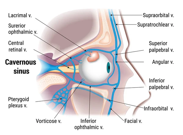 Patogénesis de la Trombosis del seno cavernoso — Vector de stock