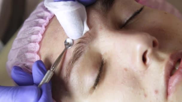 Behandelingen van de acne van het puistje knijpen. Jonge vrouw ontvangen schoonheid gezicht therapie van het puistje schoonmaken. — Stockvideo