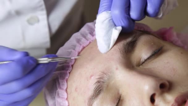 美容院的年轻 wonan 的美容师挤压粉刺黑头。面部皮肤护理 — 图库视频影像
