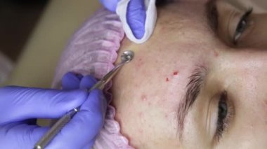 Sıkma sivilce akne tedavisi. Genç kadın Güzellik yüz tedavi sivilce temizleme alan.