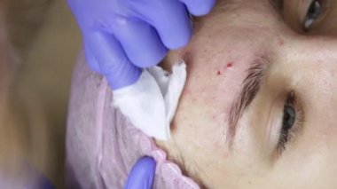 Sıkma sivilce akne tedavisi. Genç kadın Güzellik yüz tedavi sivilce temizleme alan.