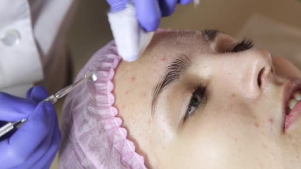 Косметолог стискає прищі чорні голови з носа за допомогою прищика поп-інструменту — стокове відео