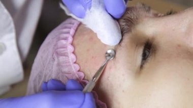 burun sivilce popper aracıyla sivilce siyah nokta sıkma güzellik uzmanı