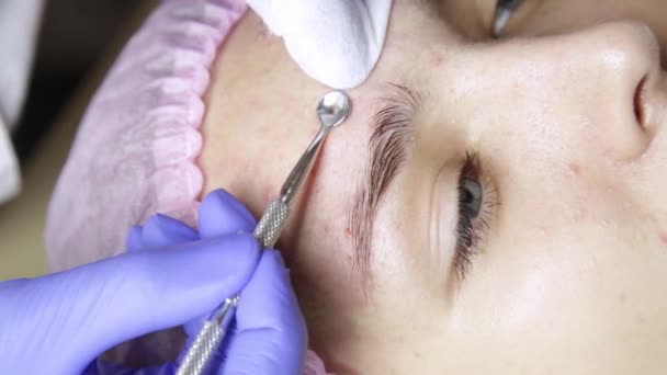 Косметолог выдавливает прыщи из носа с помощью прыщавого поппера — стоковое видео
