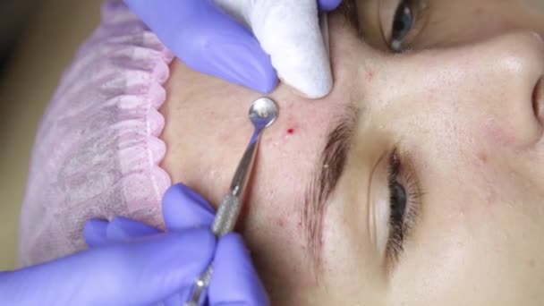 Kosmetikerin quetscht Pickel-Mitessern mit Pickel-Popper-Werkzeug aus Nase — Stockvideo