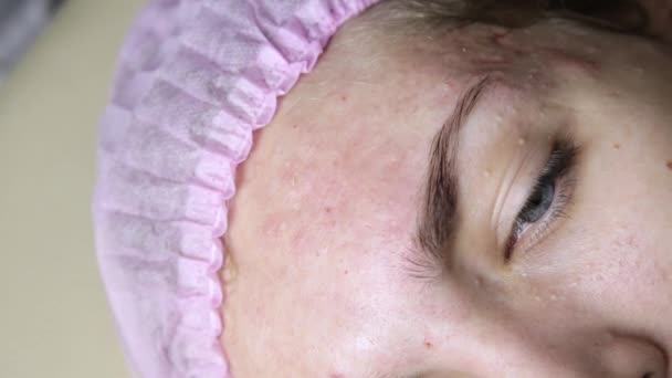 Behandelingen van de acne van het puistje knijpen. Jonge vrouw ontvangen schoonheid gezicht therapie van het puistje schoonmaken. — Stockvideo