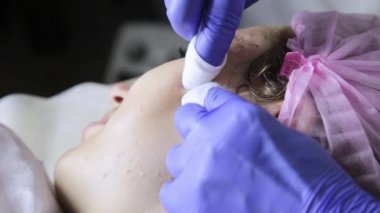 Sıkma sivilce akne tedavisi. Genç kadın Güzellik yüz tedavi sivilce temizleme alan.