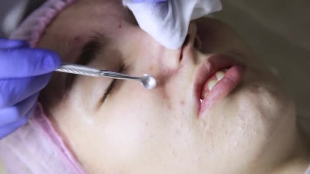 Beautician squeezing pimple blackheads from nose with pimple popper tool — Stock Video