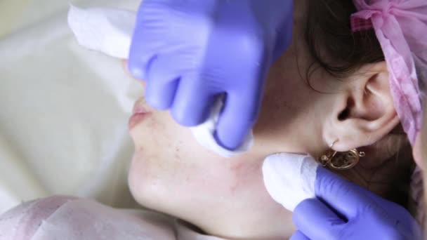 Behandelingen van de acne van het puistje knijpen. Jonge vrouw ontvangen schoonheid gezicht therapie van het puistje schoonmaken. — Stockvideo