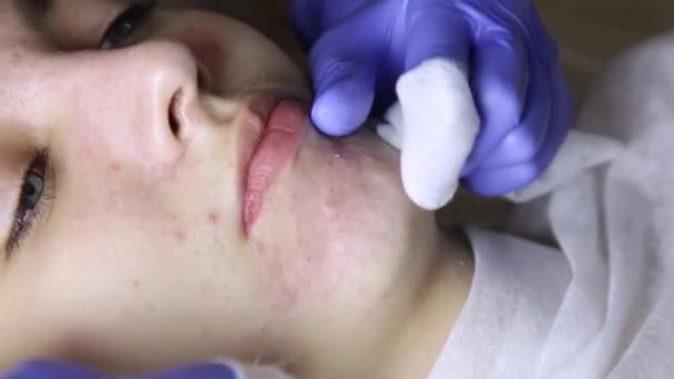 Esthéticienne serrant boutons points noirs pour les jeunes wonan dans le salon de beauté. soin du visage — Video