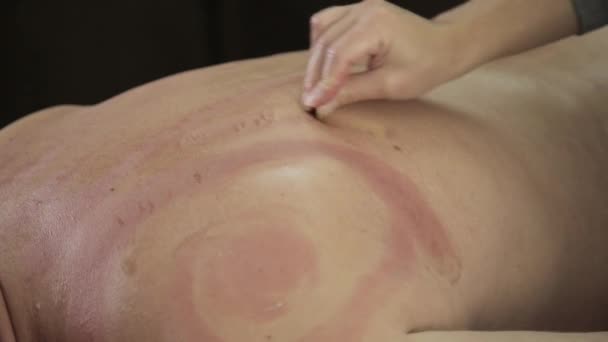 Альтернативная медицина. Акупрессура на спине мужчины со скребковым гуашем . — стоковое видео