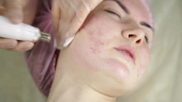 Young woman with problem skin getting a cosmetic procedures with medical equipment — Stock Video