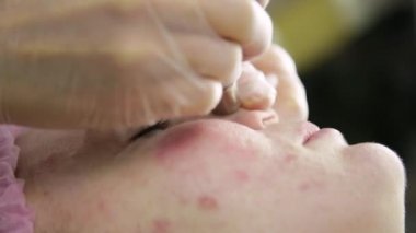 Sıkma sivilce akne tedavisi. Genç kadın Güzellik yüz tedavi sivilce temizleme alan.