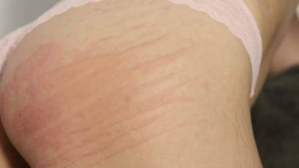 Hiperemia. una reacción alérgica de arañazos en un cuerpo. manchas y rayas rojas, edema o hinchazón de la piel — Vídeos de Stock