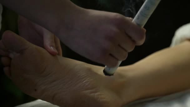 전통 중국의 술 침술 과정입니다. 중국 전통적인 치료는 신체의 열을 가리킨 — 비디오