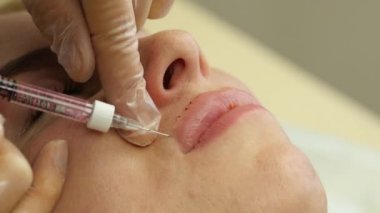 güzellik uzmanı kadının dudakları içine enjeksiyon yapmak. dudak büyütme ve plastik cerrahi. 4k