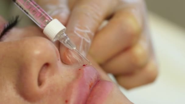 Cosmetólogo hacer la inyección en los labios de las mujeres. aumento de labios y cirugía plástica. 4K — Vídeos de Stock