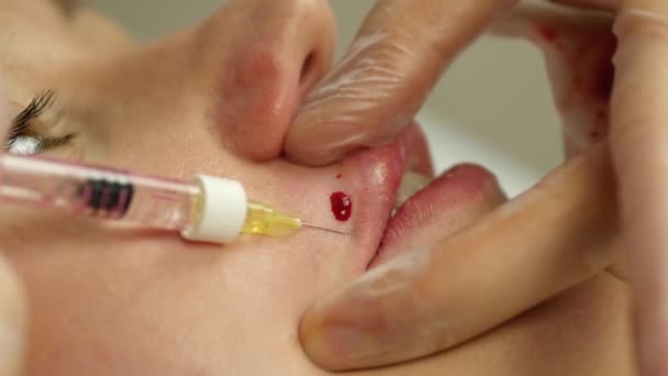 Ajakfeltöltés, a klinikán. orvos csinál ajkak injekciós botox. lassú mozgás — Stock videók