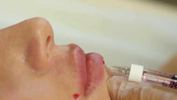 Schoonheidsspecialist maken injectie in de lippen van de dames. lipvergroting en plastische chirurgie. 4k — Stockvideo