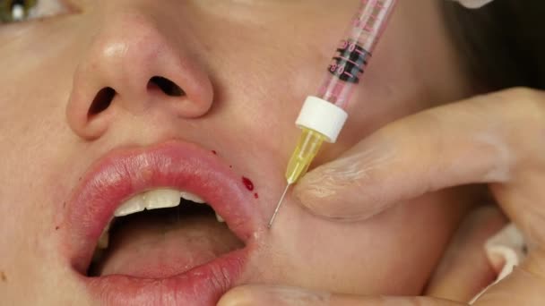 Process of lip augmentation of hyaluronic acid. patient during lips injection. 4K — Stock Video