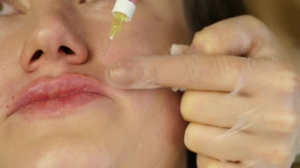 Proces van lipvergroting van hyaluronzuur. patiënt tijdens lippen injectie. Slow motion — Stockvideo