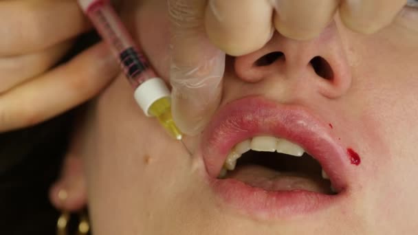 Processen att lip augmentation av hyaluronsyra. patienten under läppar injektion. 4k — Stockvideo