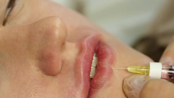 Процесс наращивания губ гиалуроновой кислоты. пациент во время инъекции губ. 4K — стоковое видео