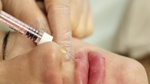 Proces van lipvergroting van hyaluronzuur. patiënt tijdens lippen injectie. 4k — Stockvideo