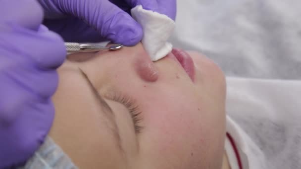 Esteticista apertando blackheads espinha para o jovem wonan no salão de beleza. cuidados com a pele facial — Vídeo de Stock