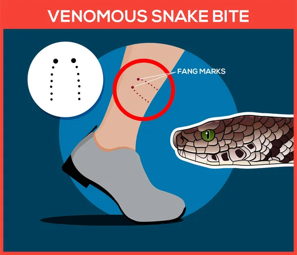 Morsure venimeuse de serpent dans la jambe. Une morsure de serpent. Attention aux serpents. Illustrations vectorielles plates — Image vectorielle