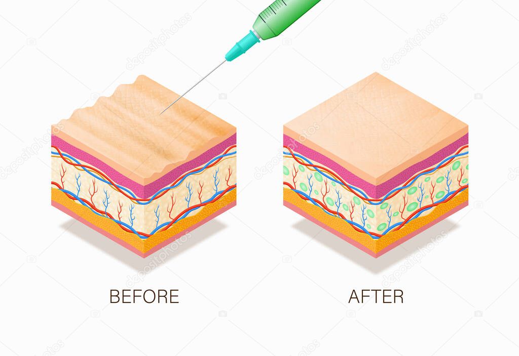 Anti-aging concept with before and after beauty treatment. Good example of how it works cosmetic filler or Dermal fillers as a cream or injection. Vector illustration skin structure. 