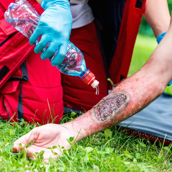 Medical Worker Treating Burns Male Hand First Aid Treatment Outdoors — Stock Photo, Image