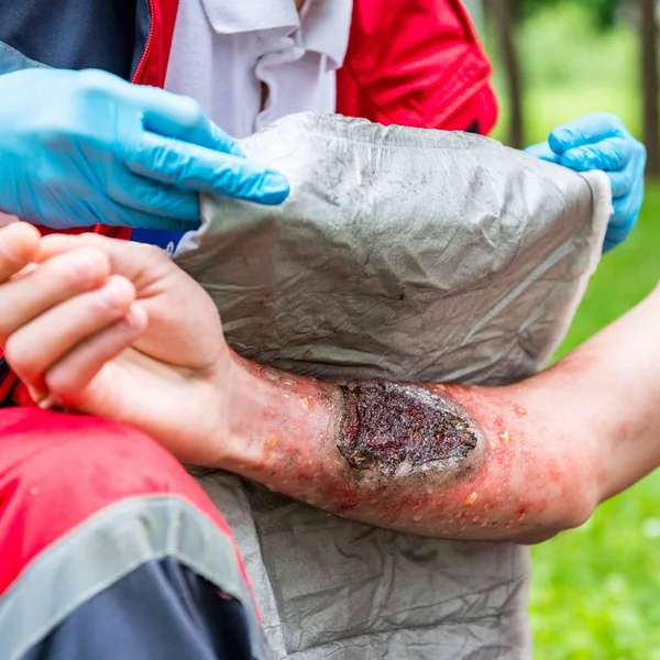 医务工作者在男性手上治疗烧伤 户外急救治疗 急救实践 — 图库照片