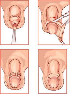    illustration of circumcision of the foreskin of the penis clipart