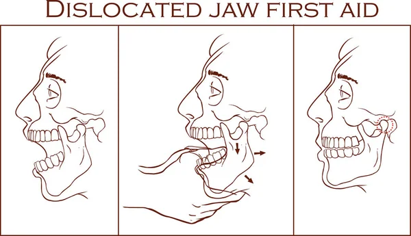 Ilustração vetorial de um primeiro socorro mandíbula deslocada —  Vetores de Stock