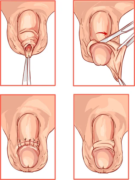 Ilustración de la circuncisión del prepucio del pene — Archivo Imágenes Vectoriales