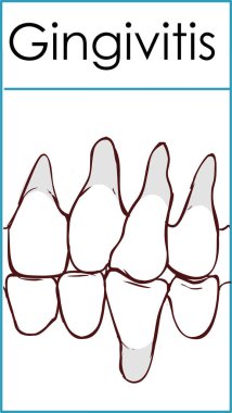 Dişeti iltihabı. Dişeti iltihabı. Vektör çizim üzerinde olduğunu