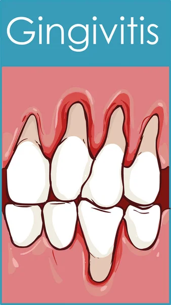 Gingivitis. Inflamación de las encías. Ilustración vectorial en es — Vector de stock