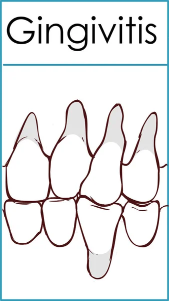 Gengivite. Infiammazione delle gengive. Illustrazione vettoriale su è — Vettoriale Stock